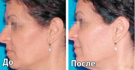 melslom_tiffimedspa